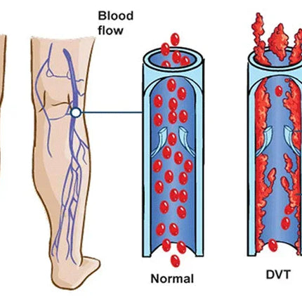 Collant a compressione medica 15-20 MmHg Calze di supporto graduate per infermieri Stecche per tibia Volo Viaggi Vene varicose