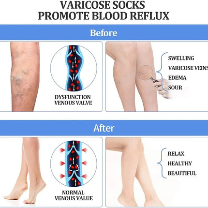 Collant a compressione medica 15-20 MmHg Calze di supporto graduate per infermieri Stecche per tibia Volo Viaggi Vene varicose